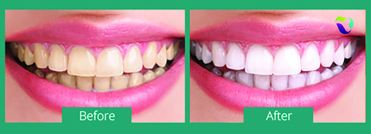 Dentist Bellevue WA - Things to Consider Before Teeth Whitening - Cooley  Smiles