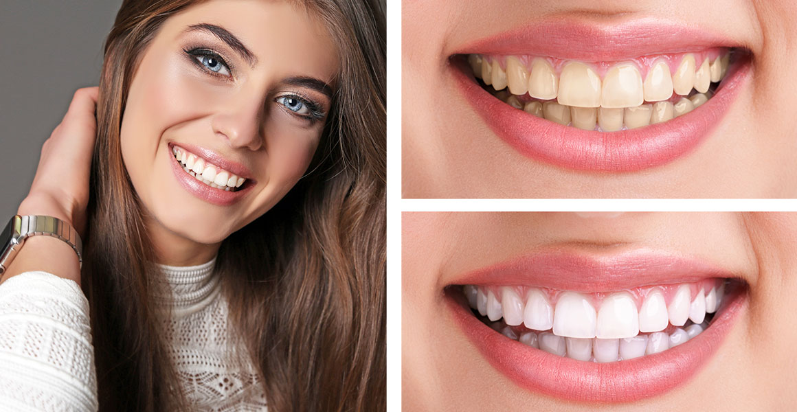 before and after yellow teeth whitening best dental clinic in bellevue