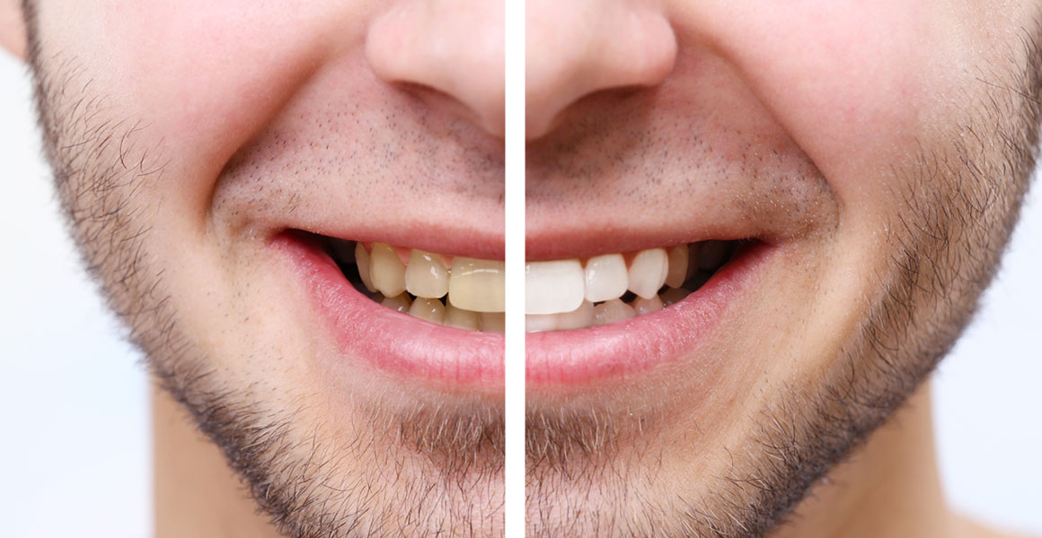 before and after whitening teeth best dental clinic in bellevue