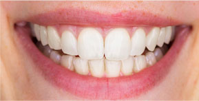 white teeth best dental clinic in bellevue