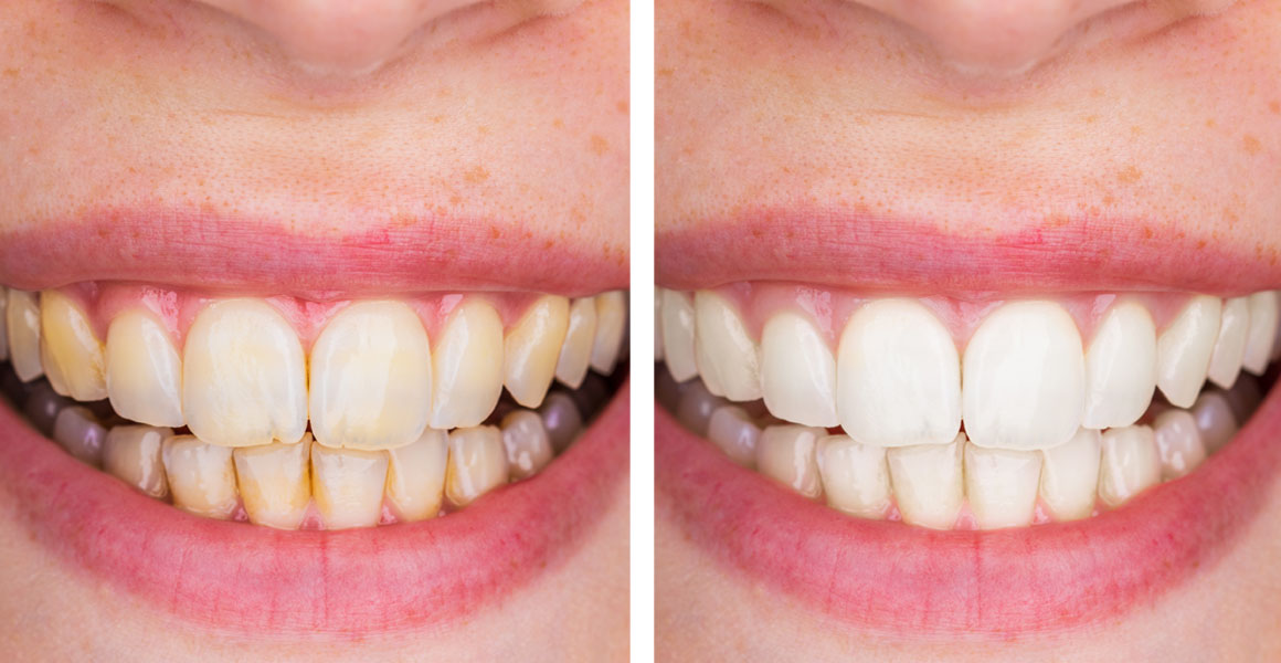 before and after teeth whitening best dental clinic in bellevue
