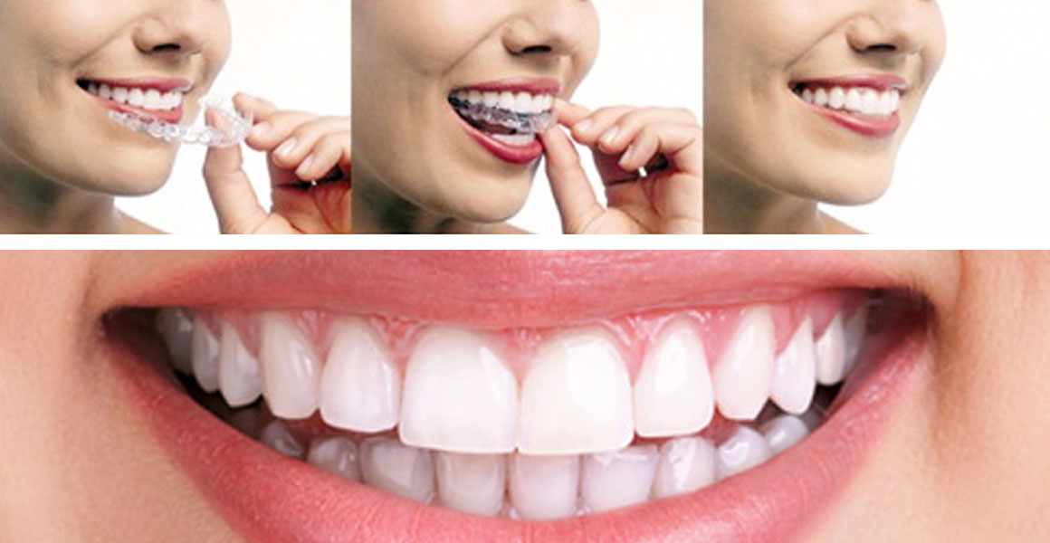 invisible braces by best dental clinic in bellevue